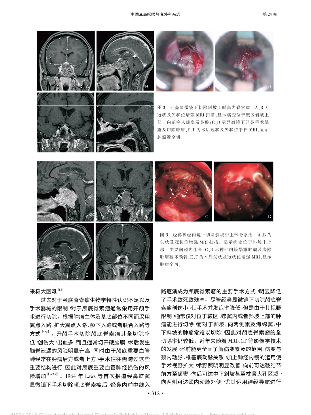 十、脊索瘤-中枢神经与头部疾病影像诊断-医学